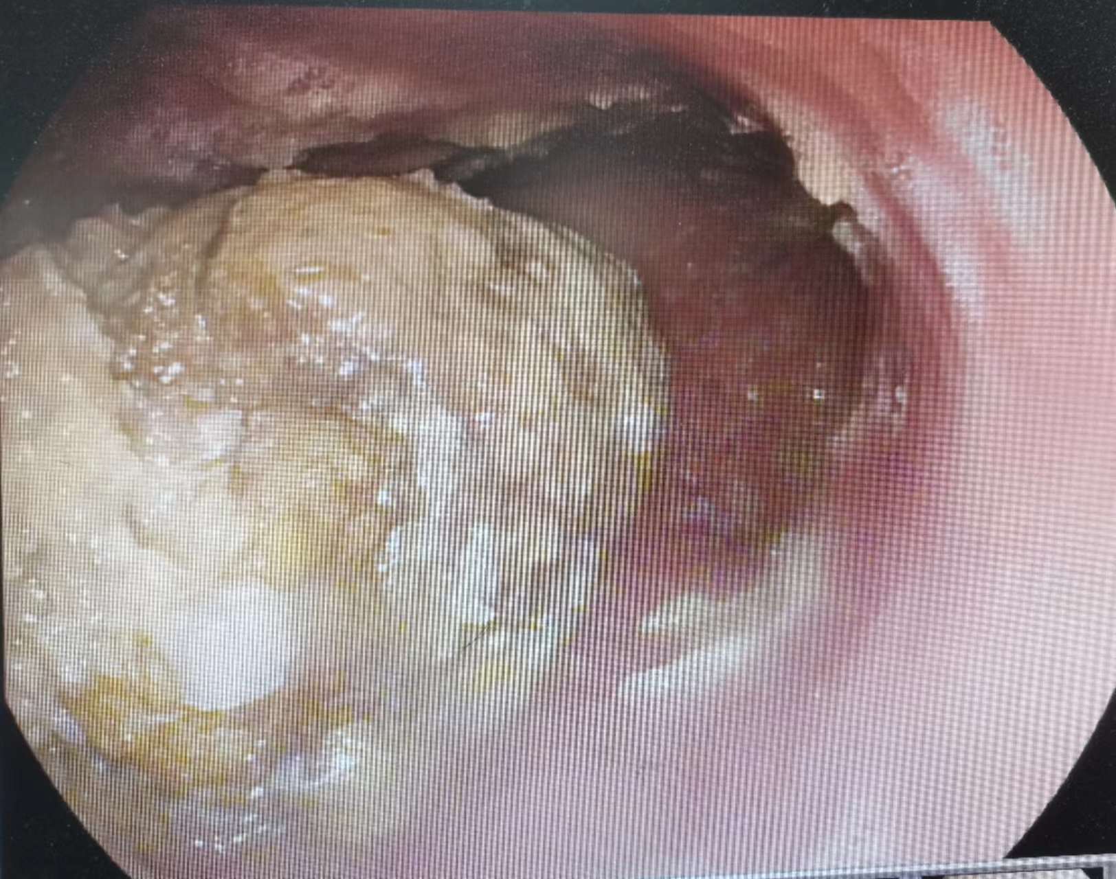 令人沒想到的是,結石周圍黏膜已經形成大面積潰瘍糜爛,胃角部位已經有